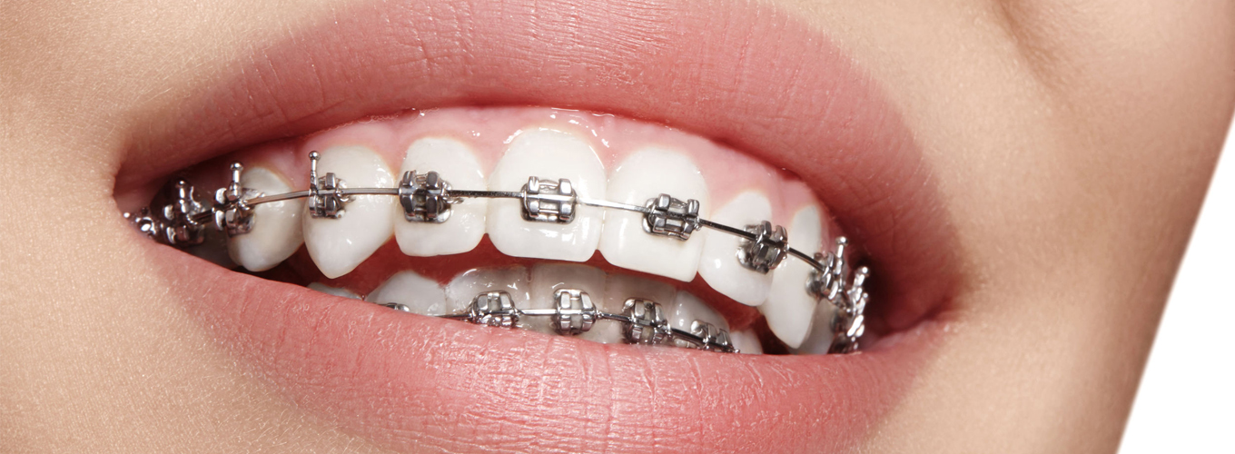  Metal Braces Treatment in Al Ain | 20+ Years of Experience